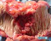 colorectal-surgery1