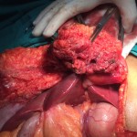 Epigastric port recurrence invading falciform ligament and adjacent liver