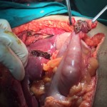 Recurrent nodule in GB fossa invading transverse colon
