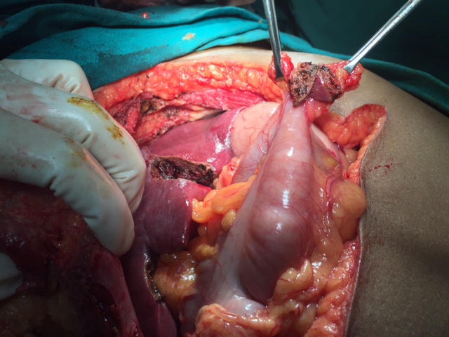 CT scan showing recurrence at epigastric port site