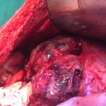 Subhepatic deposit at surgery for recurrence
