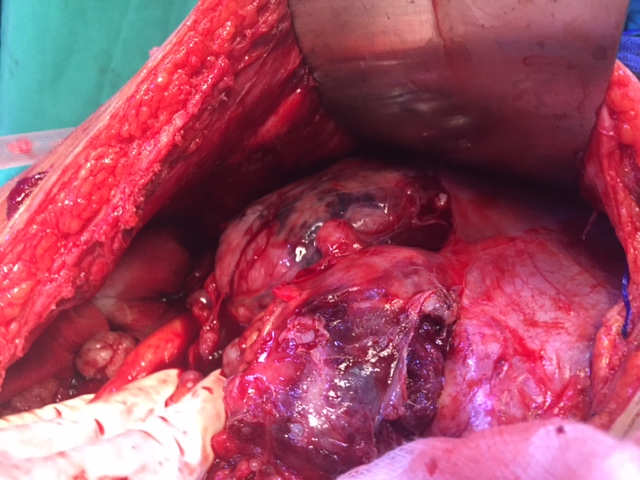 Subhepatic deposit at surgery for recurrence