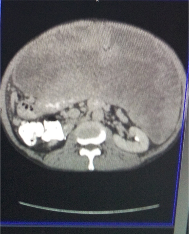 CT showing extensive disease prior to 1st surgery in 2012