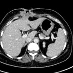 CT scan showing recurrence at epigastric port site