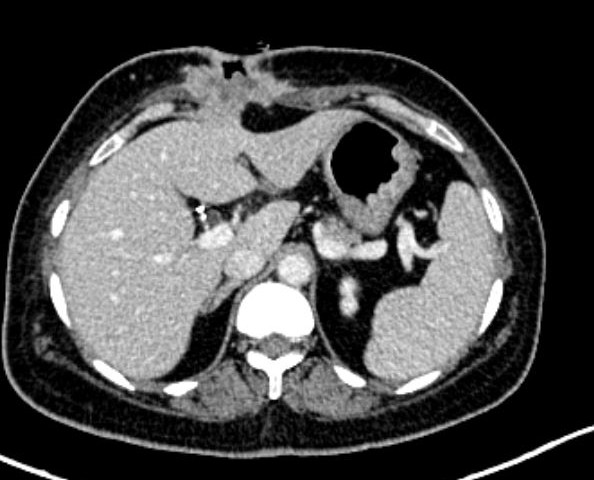 CT scan showing recurrence at epigastric port site