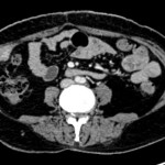 CT scan showing recurrent nodule at site of right flank port