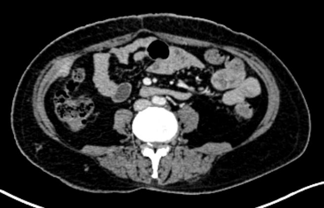 CT scan showing recurrent nodule at site of right flank port