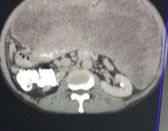 CT showing extensive disease prior to 1st surgery in 2012