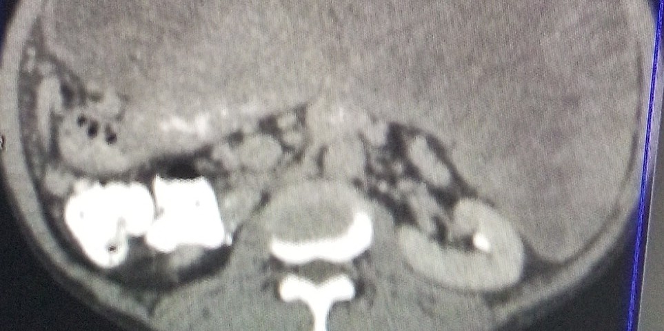 CT showing extensive disease prior to 1st surgery in 2012