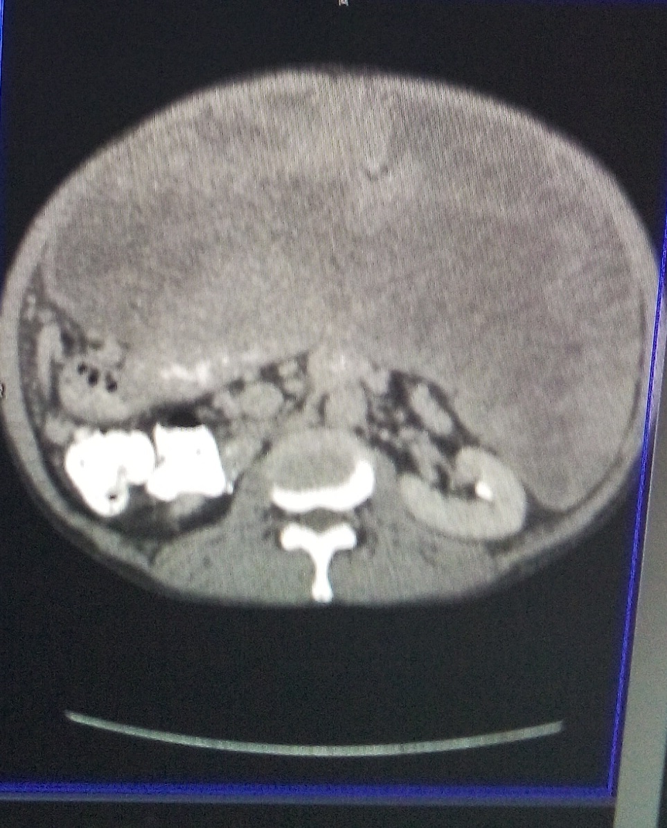 CT showing extensive disease prior to 1st surgery in 2012