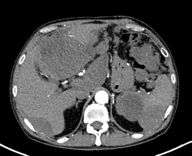 CT showing recurrent disease 2016