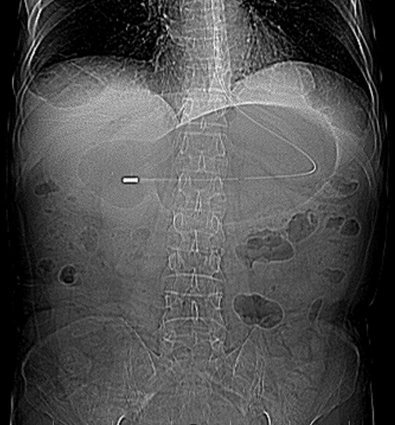 Plain X ray abdomen showing a dilated stomach with nasogastric tube in situ
