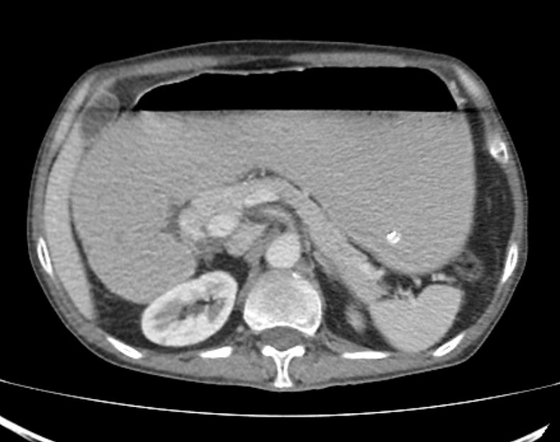 CT scan abdomen showing dilated stomach and proximal duodenum