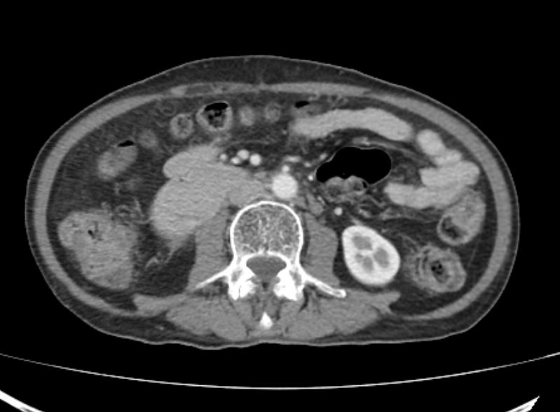 CT scan showing obstruction at level of third part of duodenum without any obvious mass lesion 
