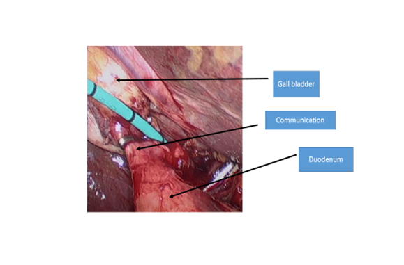 Operative-Photograph-showing-communication-between-gall-bladder-and-duodenum-with-catheter-in-cystic-duct-(for-cholangiogram)