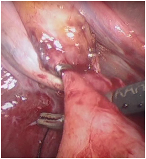 Operative-Photograph-with-clip-placed-across-the-fistula